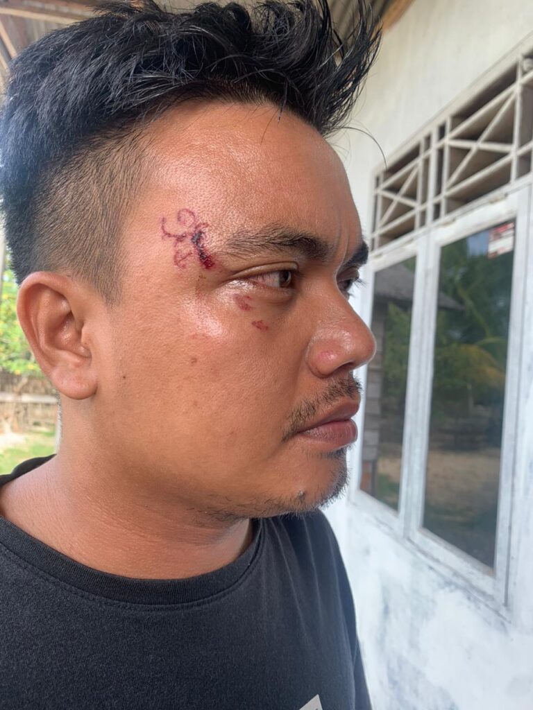 Nyaris Meregang Nyawa, Warga Langsa Terjerat Tali Pancing di Jalan lintas Seuriget Maret 25, 2023